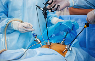 LAPAROSCOPY SURGERY